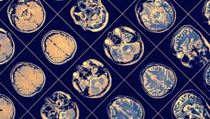 AI chẩn đoán diễn tiến bệnh Parkinson do Hãng IBM phát triển AI chẩn đoán diễn tiến bệnh Parkinson do Hãng IBM phát triển