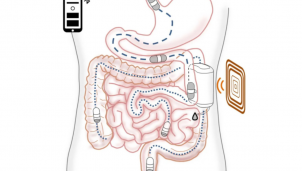 Bệnh nhân tiểu đường sẽ được cung cấp Insulin cho cơ thể mà không cần kim tiêm nhờ thiết bị cấy ghép Bệnh nhân tiểu đường sẽ được cung cấp Insulin cho cơ thể mà không cần kim tiêm nhờ thiết bị cấy ghép