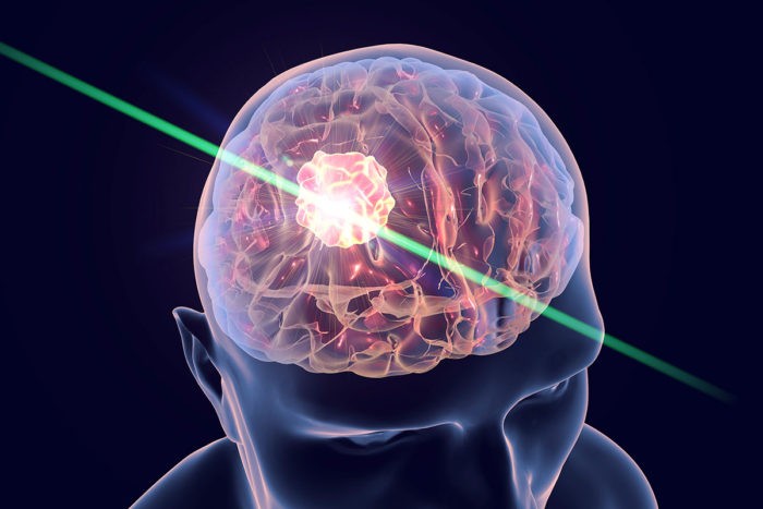 Tia laser có thể điều trị nhiều loại ung thư như ung thư não bằng cách phá hủy các khối u